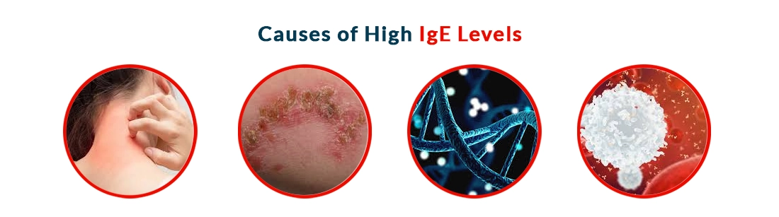 Causes of High IgE Levels